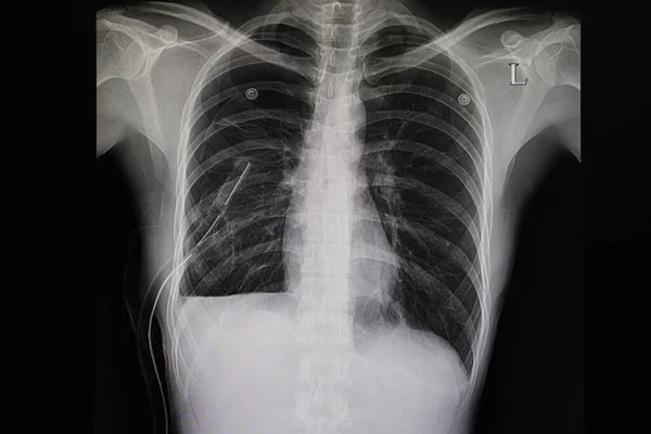 Рентгенівська Плівка Пацієнта Правою Стороною Спонтанної Пневмотораки Грудний Дренаж Невелика — стокове фото
