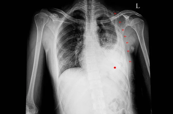 Una Radiografía Tórax Paciente Con Múltiples Fracturas Costilla Izquierda Costilla — Foto de Stock