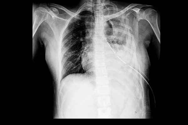 A chest xray film of a patient with multiple left rib fractures with left side large hemothorax and an intrathoracic drainage tube (ICD).  Chest radiology image in trauma and accident. Flail chest.