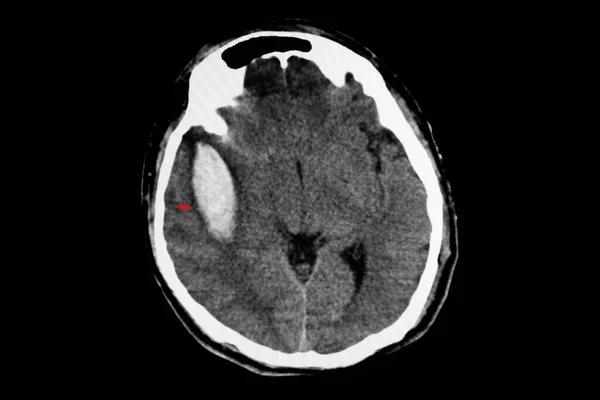 Tomografide Paryetal Oksipital Akut Intraserebral Kanama Görülüyor Hafif Orta Dereceli — Stok fotoğraf