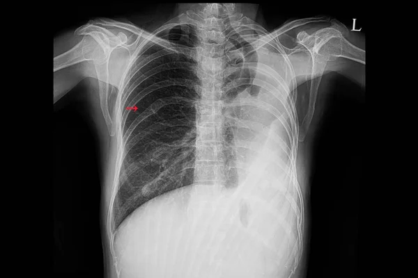 肺開胸後の患者の胸部X線フィルム 肺の外科的除去 患者は右肋骨も骨折してる — ストック写真