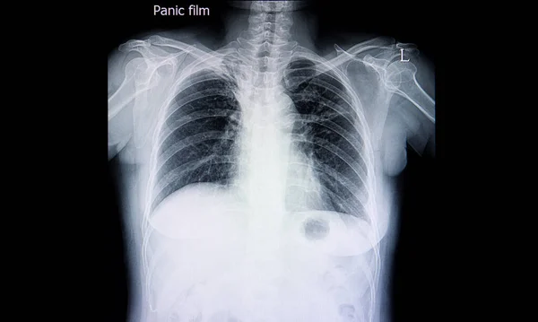 Mellkasröntgen Film Egy Tüdőtuberkulózisos Betegről Bal Felső Tüdőben — Stock Fotó