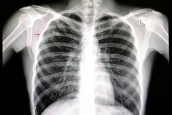 Une Radiographie Pulmonaire Patient Atteint Pneumonie Pulmonaire Supérieure Droite — Photo