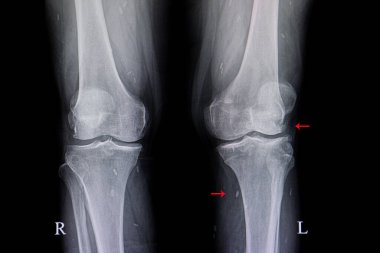 Xray image of knees with degenenative osteoarthritis and calcified soft tissue cysticercosis. Chronic knee pain. clipart