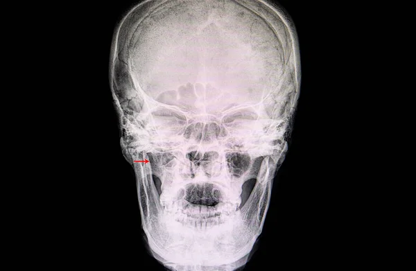 Рентгеновская Пленка Пациента Правым Параназальным Синуситом — стоковое фото