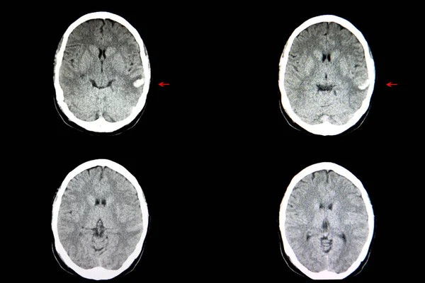 교통사고로 뇌출혈 환자의 스캔했습니다 왼쪽측 절부에 — 스톡 사진
