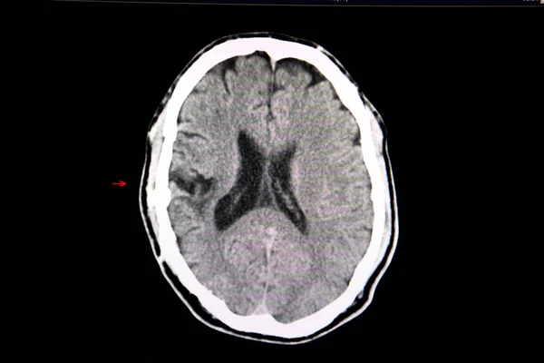 Tomografía Computarizada Del Cerebro Paciente Con Craneotomía Previa Hemorragia Intracerebral — Foto de Stock