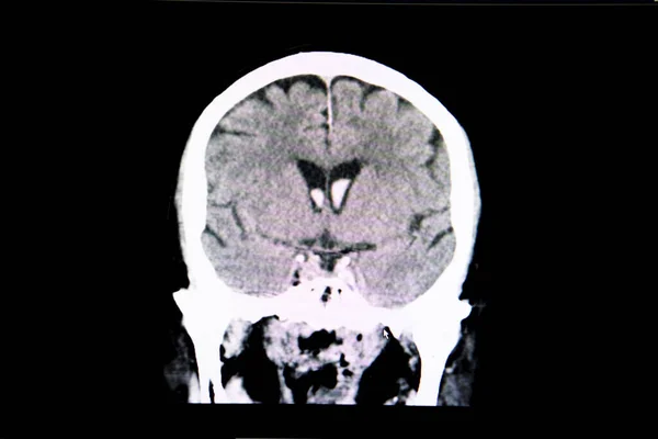 颅内出血合并出血性脑卒中患者脑的Ct扫描 侧脑室有血 — 图库照片
