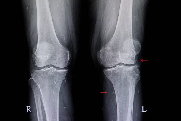 Imagen Rayos Rodillas Con Osteoartritis Degenativa Cisticercosis Calcificada Tejidos Blandos — Foto de Stock