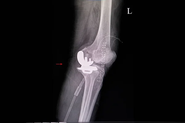 Röntgenfoto Van Linkerknie Van Een Patiënt Met Degeneratieve Artrose Getoond — Stockfoto
