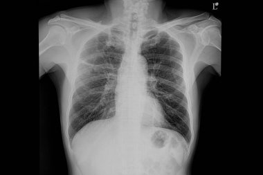 A chest x-ray film of a patient with pneumonia in his right middle lung. clipart