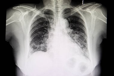 A chest xray film of a patient with cardiomagaly, congestive heart failure and pulmonary edema. clipart