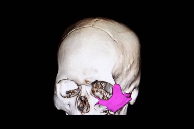 CT scan of a skull of an traumatic brain injuried patient showing fractures wall of left maxillary sinus, floor of orbit and zygomatic arch. Facial injury. clipart