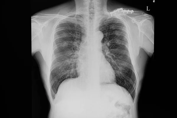경골의 골절되고 수술용 다수의 갈비뼈로 고정이 사고를 환자의 엑스레이 — 스톡 사진