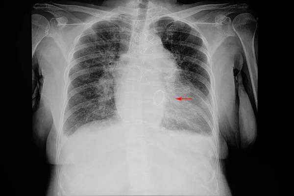 Een Borst Ray Film Van Een Vrouwelijke Patiënt Met Cardiomegalie — Stockfoto