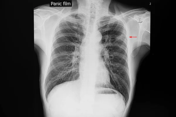 Mellkasröntgen Felvétel Egy Bal Felső Tüdő Beszivárgott Betegről Tuberkulózis Valószínűleg — Stock Fotó