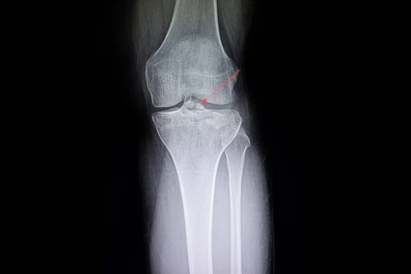 Radiografía Una Rodilla Paciente Que Muestra Fractura Cerrada Intraarticular Columna — Foto de Stock