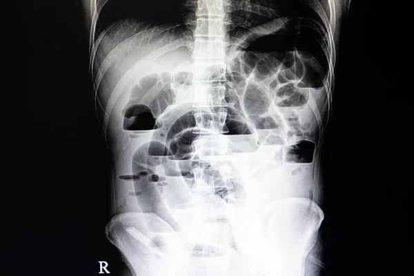 小さな腸閉塞患者の腹部X線フィルムは 空気の流体レベルと拡張腸ループを示しています — ストック写真