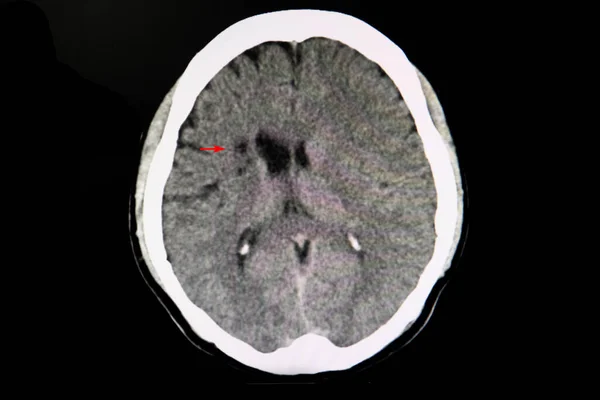 脑卒中患者的Ct脑扫描显示右侧基底神经节和冠状结节的梗死区 — 图库照片