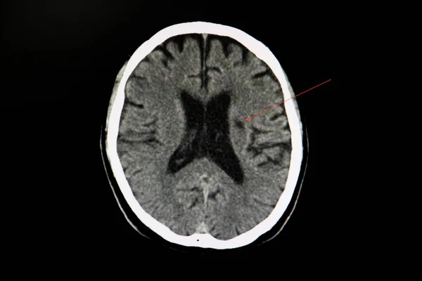 脑卒中左冠状脑梗死合并脑萎缩的Ct扫描 — 图库照片