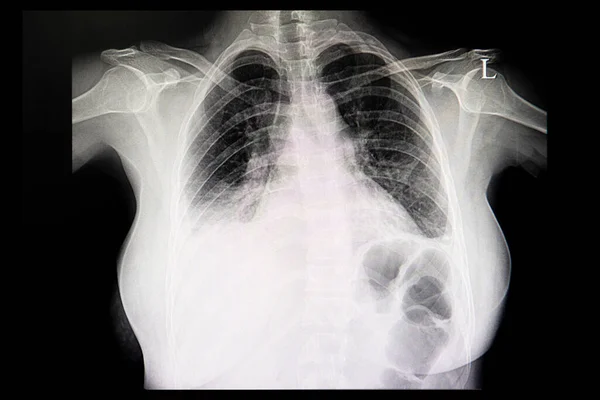 Una Radiografía Tórax Paciente Concardiomegalia Ambos Pulmones Derrame Pleural — Foto de Stock