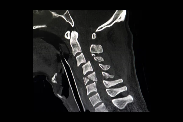交通事故のある患者の子宮頸椎のCtスキャンは C5における子宮頸椎の骨折を示す — ストック写真