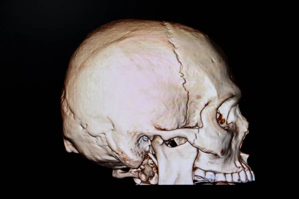 右頬骨骨折を示す交通事故患者の頭蓋骨の3Dレンダリング — ストック写真