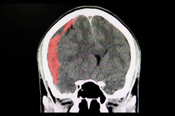 A CT scan of the brain of a patient with traffic accident showing acute subdural hematoma.