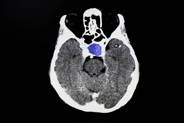 CT brain scan of a patient with pituitary tumor showing heterogenous mass in the pituitary fossa. Pituitary adenoma and apoplexy with hemorrhage in the mass.