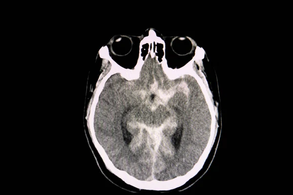 Trafik Kazası Geçiren Bir Hastanın Beyin Tomografisi Akut Subaraknoid Kanama — Stok fotoğraf