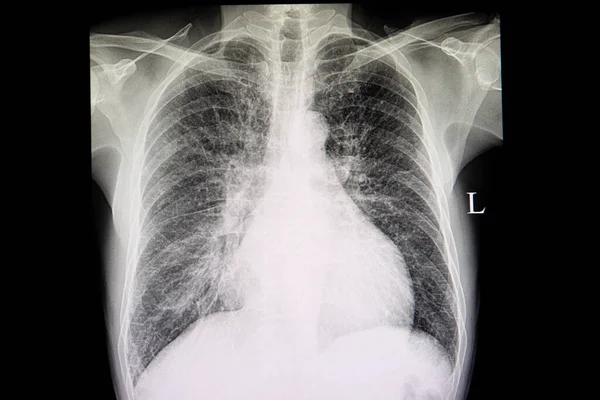 Une Radiographie Pulmonaire Patient Atteint Insuffisance Cardiaque Congestive Montrant Une — Photo