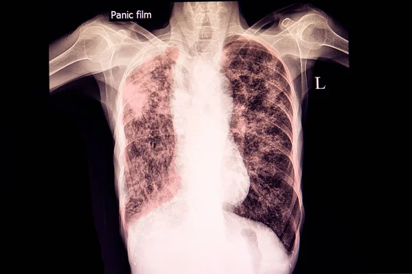 Súlyos Tüdőtuberkulózisban Szenvedő Tüdőtágulattal Járó Beteg Mellkasröntgenfelvétele — Stock Fotó