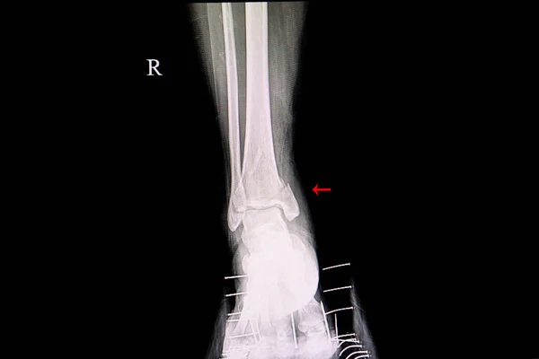 Radiografía Una Pierna Paciente Que Muestra Maléolo Lateral Fracturado — Foto de Stock