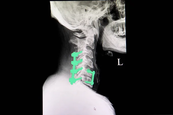 C6に沿ってロッドとネジ固定を有する患者の首のX線フィルム — ストック写真