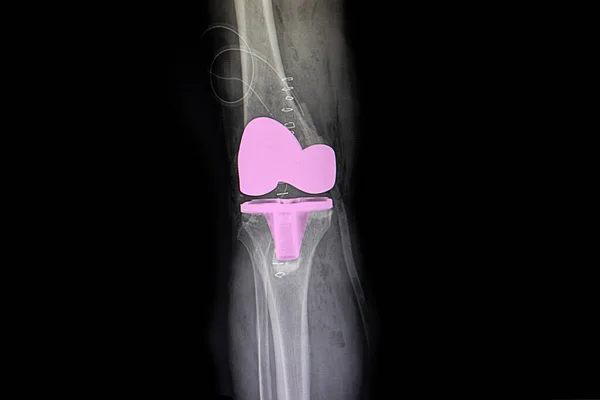 Röntgenfilm Van Een Patiënt Rechter Knie Totale Knie Geleedpokkenoperatie — Stockfoto