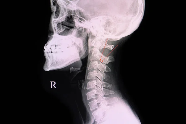 四C3椎骨体の外科的骨折を有する患者の棘X線 — ストック写真