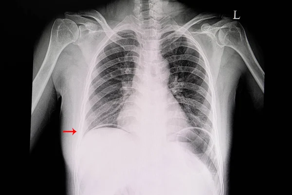 똑바로 환자의 엑스레이 오른쪽 아래에서 공기를 있습니다 위궤양을 — 스톡 사진