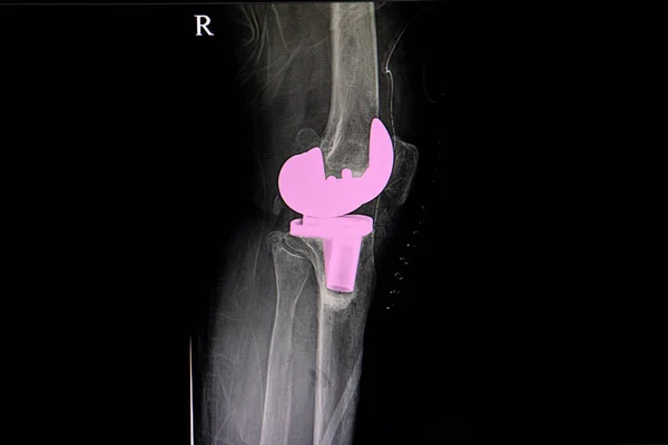 Radiografía Una Rodilla Derecha Del Paciente Después Una Operación Total — Foto de Stock