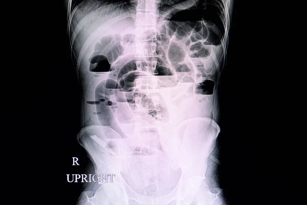 小さな腸閉塞患者の腹部X線フィルムは 空気の流体レベルと拡張腸ループを示しています — ストック写真