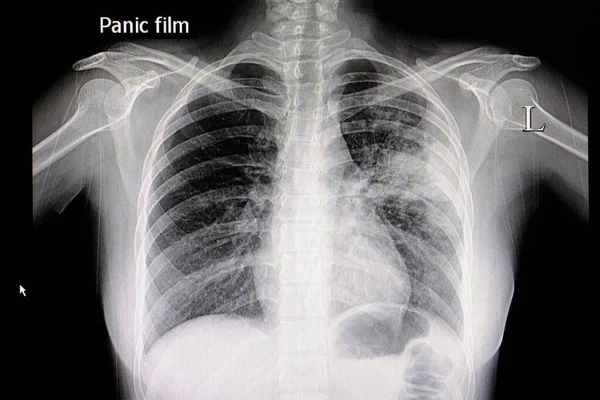 Una Radiografía Tórax Paciente Con Neumonía Pulmonar Media Izquierda — Foto de Stock