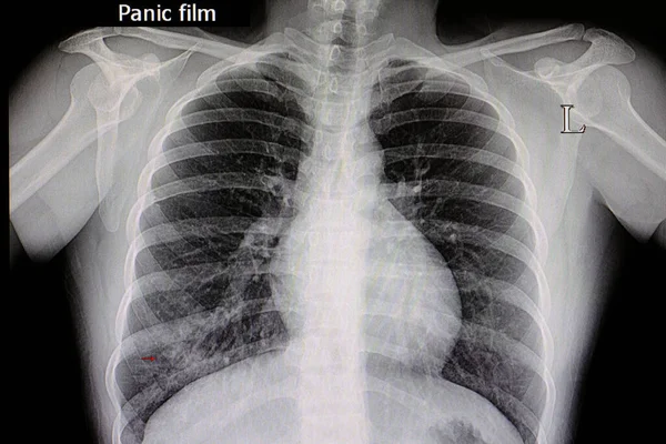 A chest xray film of a patient with  right lower lung pneumonia.