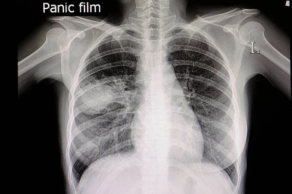 Una Radiografía Tórax Paciente Con Neumonía Pulmonar Media Derecha — Foto de Stock