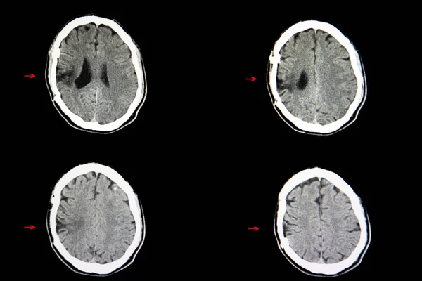 以往颅脑切除术及近期车祸致脑出血患者的Ct扫描 发现颅骨缺损和脑卒中 — 图库照片