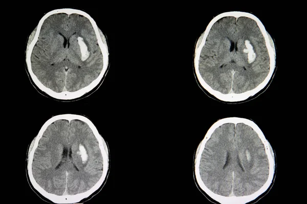 颅内大出血合并出血性脑卒中患者脑的Ct扫描 血液在大脑左半球可见 — 图库照片