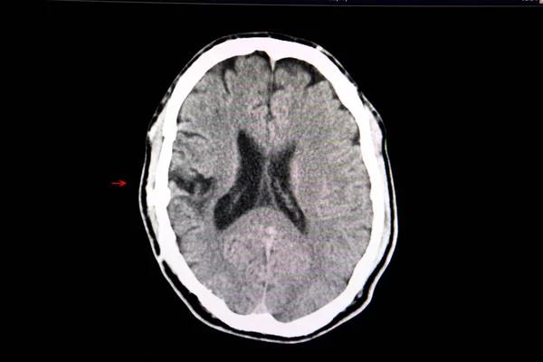 Компьютерная Томография Мозга Пациента Предыдущей Краниектомией Недавним Внутричерепным Кровоизлиянием После — стоковое фото