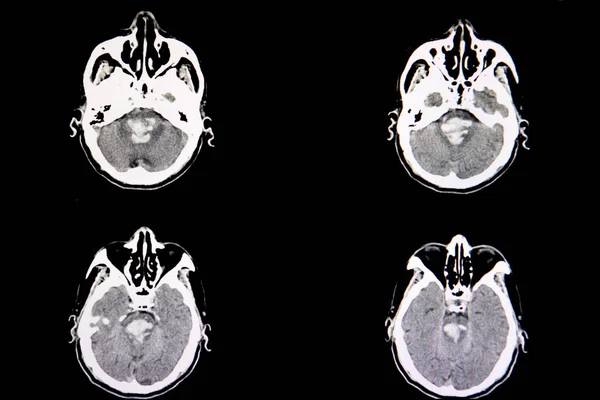 Мозга Пациента Обширным Внутричерепным Кровоизлиянием Кровоизлияния Мозг Blood Seen Pons — стоковое фото