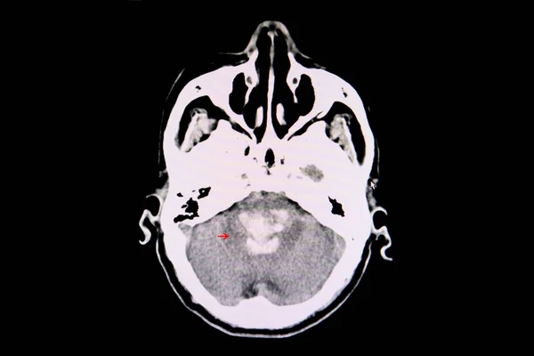 Kanamalı Intrakraniyal Kanaması Olan Bir Hastanın Beyin Tomografisi Pons Kan — Stok fotoğraf