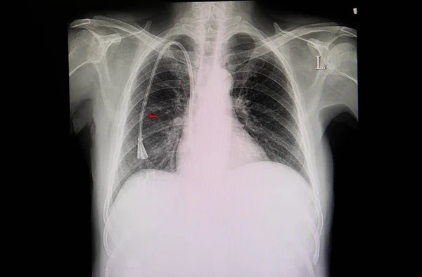 Een Röntgenfoto Van Een Nierfalen Patiënt Met Een Dubbele Lumen — Stockfoto