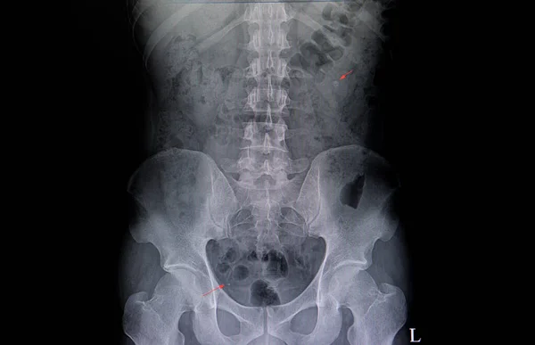 二つの尿道石を示す患者のX線像 — ストック写真