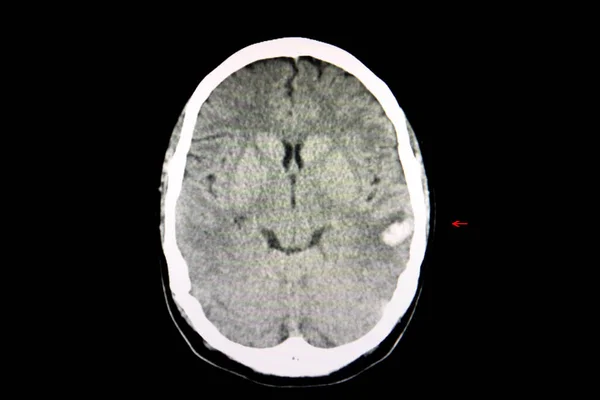 车祸致脑出血患者脑的Ct扫描 左侧时区有出血点发炎 — 图库照片